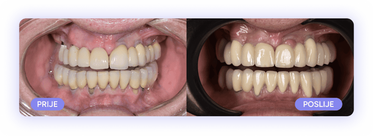 zubni most, zagreb cijena